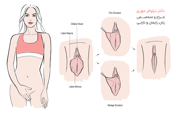 نحوه انجام جراحی لابیاپلاستی