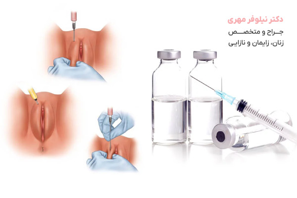 تزریق ژل و چربی به ناحیه تناسلی چیست؟