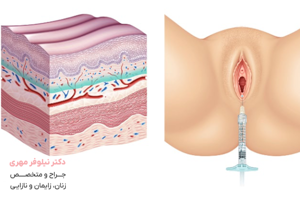 تفاوت تزریق ژل و چربی به ناحیه تناسلی