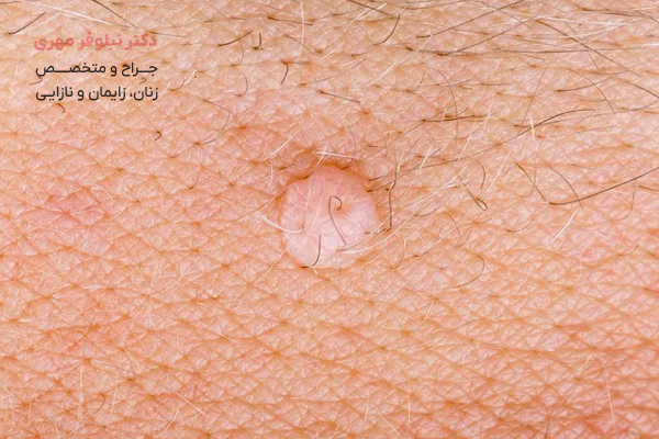 تفاوت زگیل تناسلی با سایر ضایعات پوستی