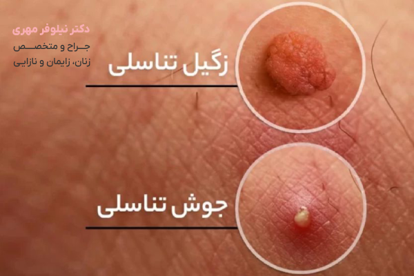 زگیل تناسلی چیست؟