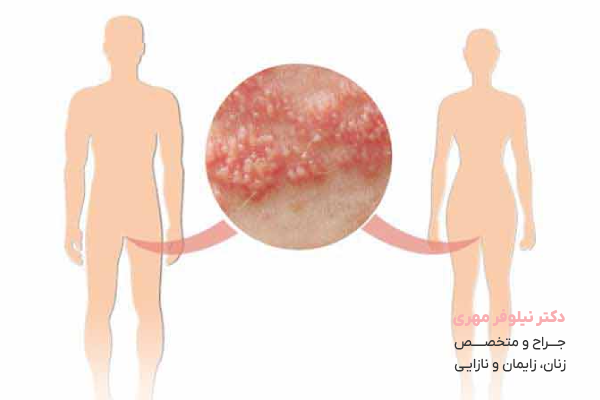 علائم و نشانه های زگیل تناسلی