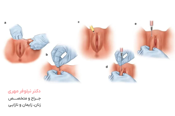 مراحل انجام تزریق ژل و چربی به ناحیه تناسلی