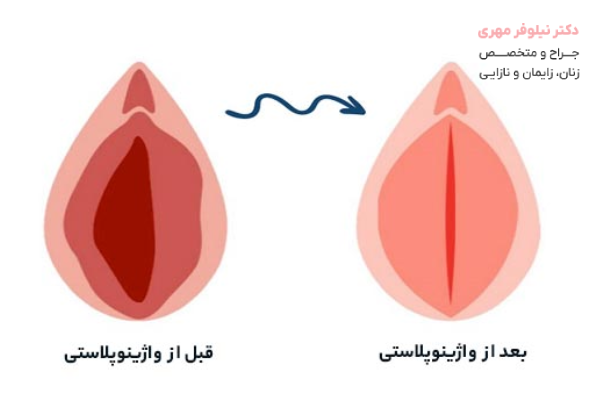روش انجام لابیاپلاستی و واژینوپلاستی بهصورت همزمان