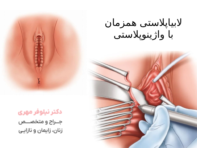 لابیاپلاستی همزمان با واژینوپلاستی