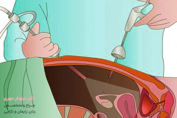 تشخیص حاملگی خارج از رحم