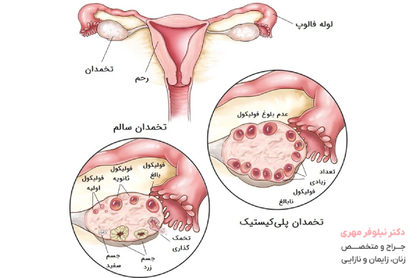 درمان کیست تخمدان خطرناک