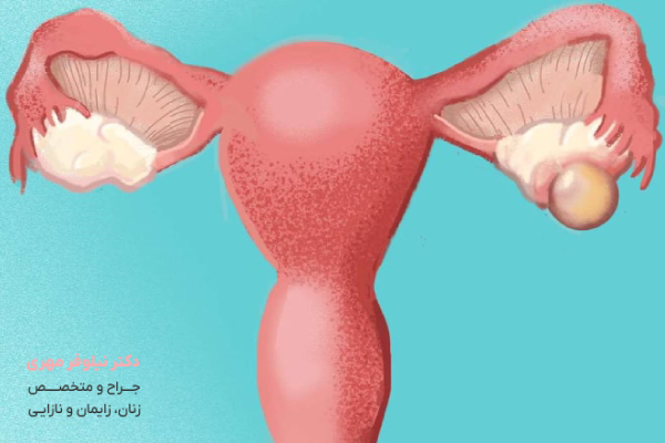 علائم کیست تخمدان خطرناک